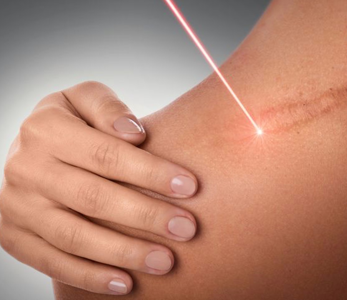LASER Scar Treatment 